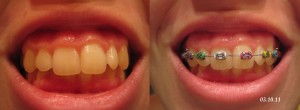Зубы с брекетами